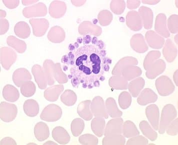 پدیده تجمع اقماری پلاکت‌ها در اطراف لکوسیت‌های نوتروفیل