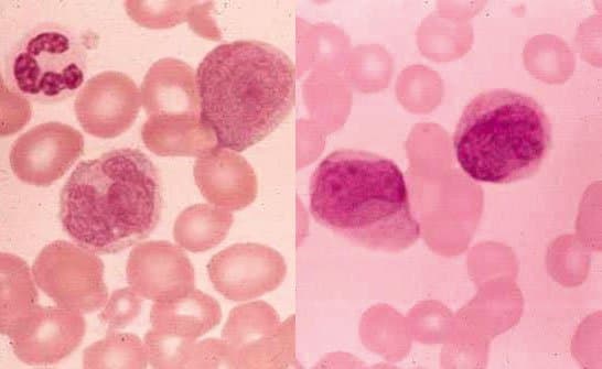 لوسمی حاد میلومنوسیتیک  M4 -AML