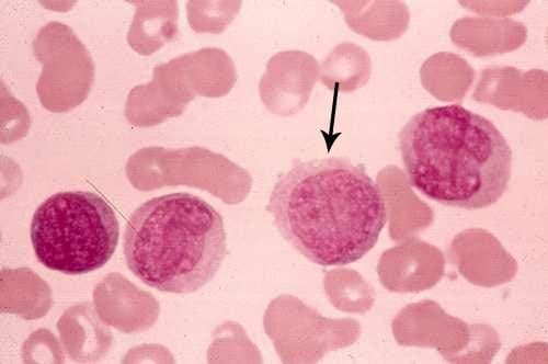 لوسمی حاد میلومنوسیتیک  M4 -AML