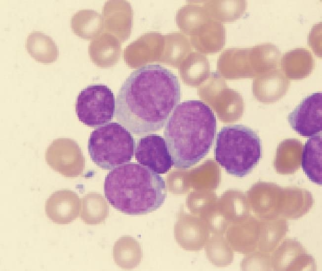 لوسمی حاد میلومنوسیتیک  M4 -AML