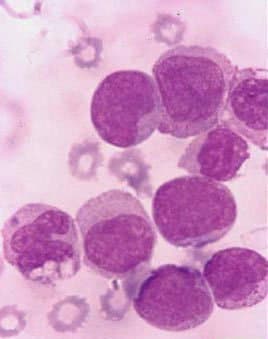 لوسمی حاد میلومنوسیتیک  M4 -AML