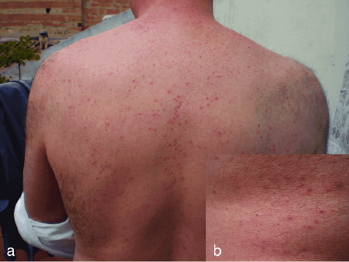 درمانیسوس گالینه کنه پرندگان